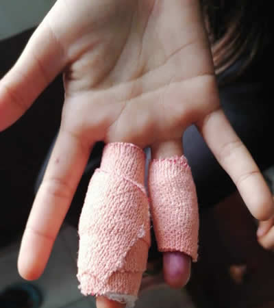 La petite de 9 ans coupée  au doigt.