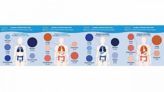 Cancer : légère baisse du nombre de nouveaux cas