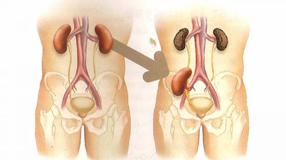 Appel à solidarité : besoin de fonds pour une transplantation des reins