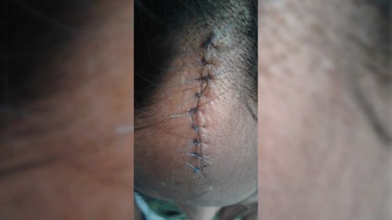 À Port-Louis : un échafaudage s’effondre des clients gravement blessés