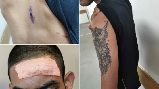 En revenant de la boutique à Vallée-Pitot : un jeune agressé et dépouillé à coups d’arme tranchante