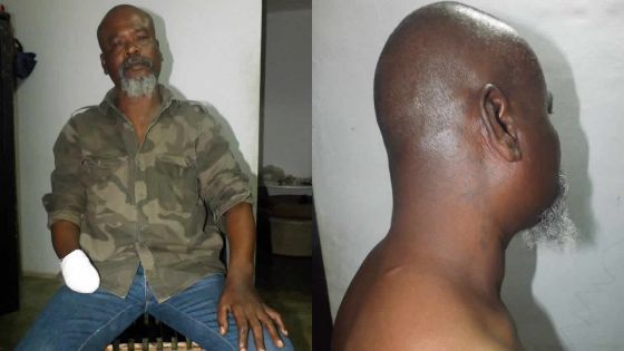 Amputé de la main droite après une agression - Louis Erol Isabelle : «Nanyen mo pa kapav fer…»