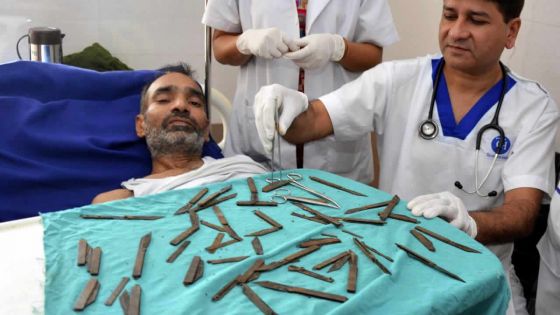 Inde : un homme se fait opérer pour enlever 40 couteaux de son estomac
