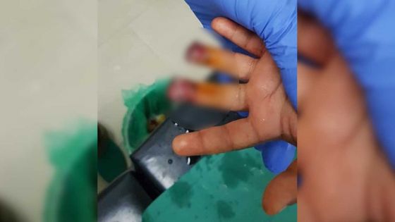 Une fillette de 3 ans blessée à l'école pré-primaire : bras de fer entre ses parents et la direction de l'école