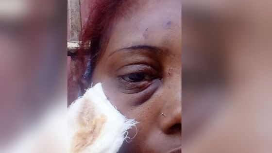Roche-Bois : une femme accuse sa voisine de l’avoir blessée à l’œil