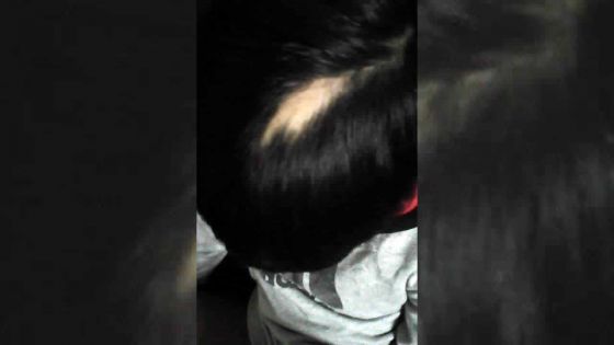 Des parents réclament Rs 10 M à une enseignante pour avoir arraché les cheveux de leur fils 
