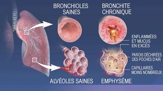 Covid-19 - Patients à risque : les maladies respiratoires se classent en 3e position