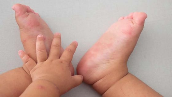 Santé pédiatrique : les cas de la maladie mains-pieds-bouche en hausse 
