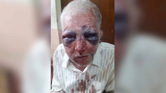 Sur fond de vengeance : un retraité défiguré à coups de pierre par un jeune de 18 ans