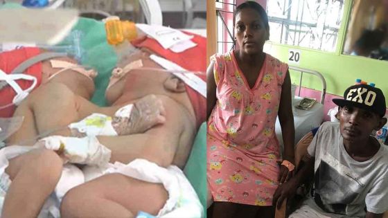 Bébés siamois à Bangalore : le couple Papillon convoqué par les médecins de l’hôpital