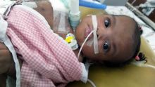 Opération réussie de Cléanne : une première mondiale pour l’équipe médicale de Narayana Health