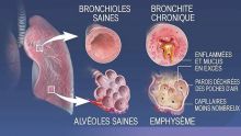 Maladie saisonnière : hausse des cas de bronchiolite chez les jeunes enfants