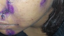 À Pailles : une jeune femme sauvagement agressée par son époux