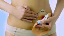 Colostomy bag : la qualité de nouvelles poches déplorée