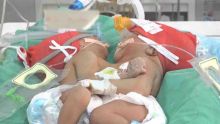 Opération des sœurs siamoises : elles sont arrivées à l’hôpital Narayana Hrudayalaya à Bangalore  