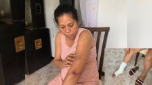 Trois femmes percutées sur un arrêt d’autobus - Elieta, rescapée : « Mo trouv sa loto-la vinn direk lor nou» - une des blessées amputée d’une jambe 