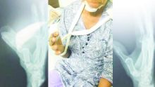 À l'hôpital Dr A. G. Jeetoo : admise avec un pouce disloqué, elle se retrouve avec une fracture