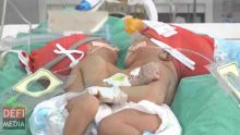 Jumelles siamoises : l’état de santé des bébés stable