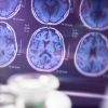 Résultats positifs confirmés pour un médicament anti-Alzheimer